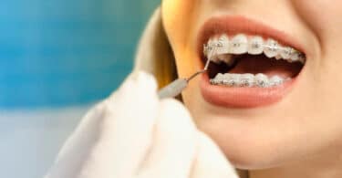 Can Insurance Cover Braces?