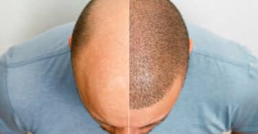 Insurance Coverage for Hair Restoration